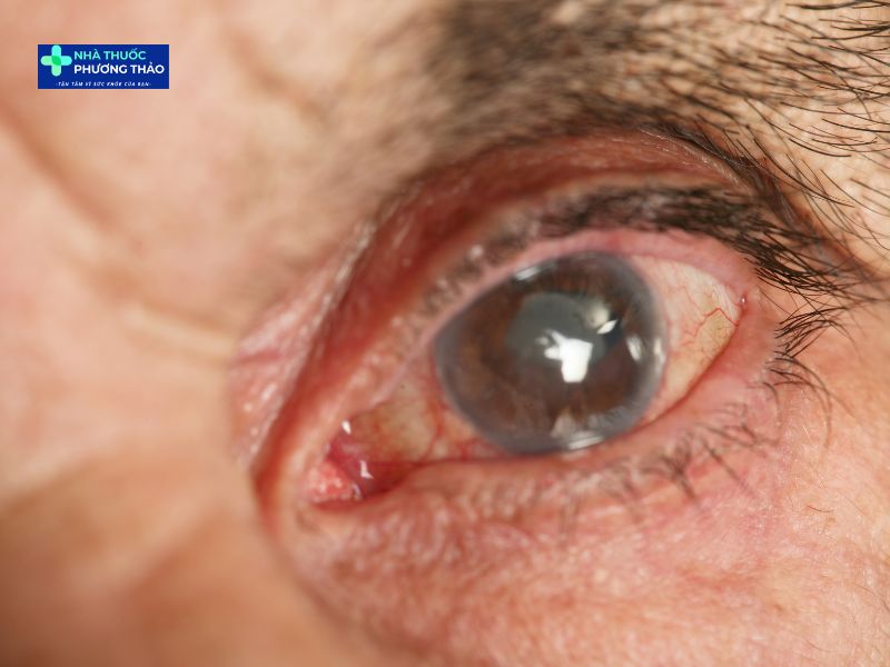 Bệnh đục thủy tinh thể ở người già