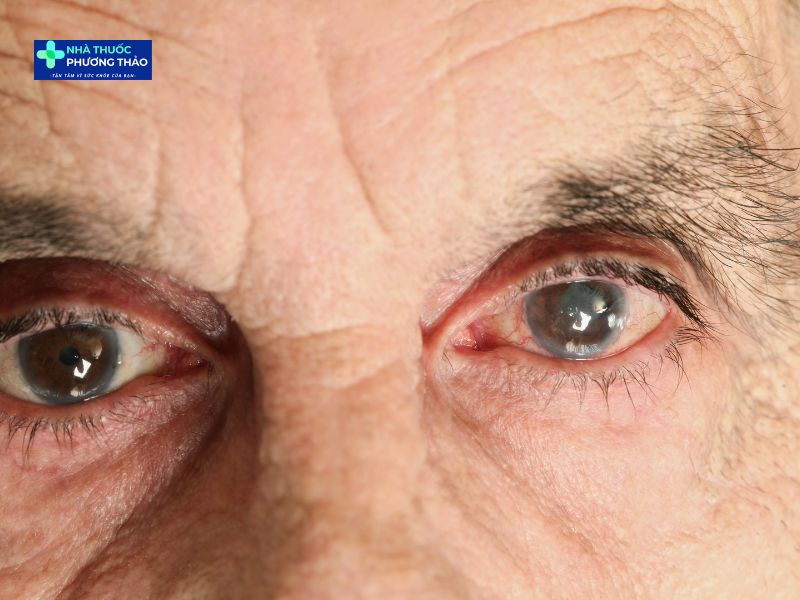 Glocom (Tăng nhãn áp) ở người già